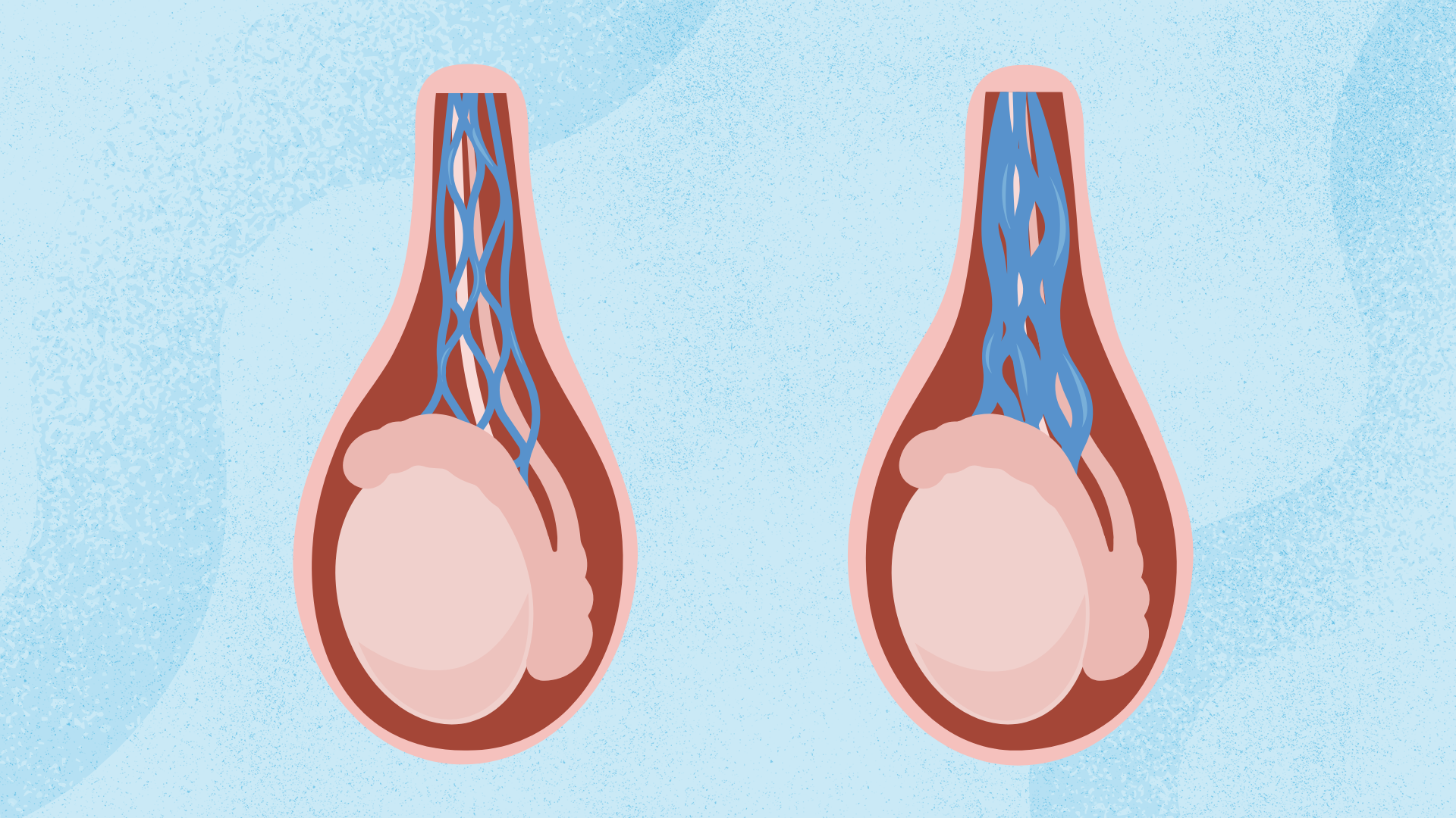 Scrotal & Testicular Swellings - Velura Clinic